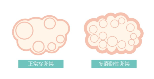 多嚢胞性嚢胞症候群（PCOS）とは